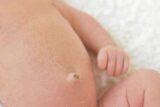 臍ヘルニアとは？赤ちゃんだけでなく大人も発症する？手術が必要？