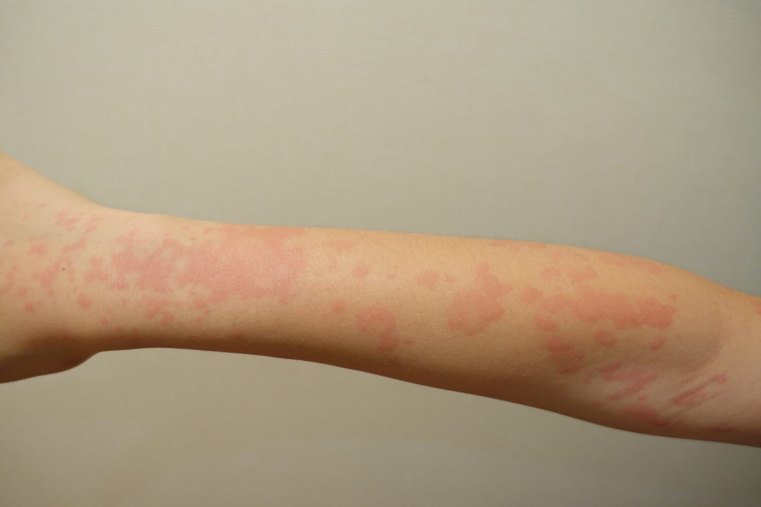 関節リウマチの診断