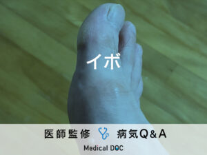 「イボ」ができる原因はご存知ですか？種類や治療についても解説！