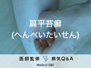 「扁平苔癬（へんぺいたいせん）」とは？原因・がん・治療法も解説！