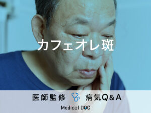 「カフェオレ斑（茶色のあざ）」ができる原因はご存知ですか？医師が監修！