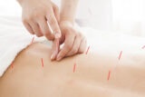 「ダイエット鍼」って本当に効果があるの？