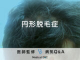 「円形脱毛症」の原因や治療法はご存知ですか？医師が監修！