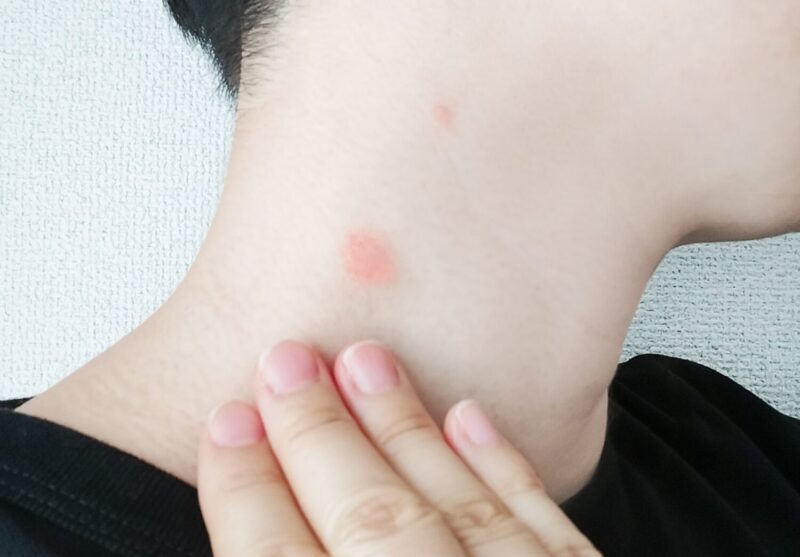 他にどこに病変が現れる可能性がありますか?