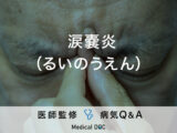 「涙嚢炎」を発症すると現れる症状・原因・発症しやすい人の特徴はご存知ですか？