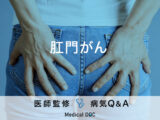 「肛門がん」を疑う症状・原因はご存知ですか？医師が監修！