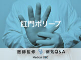 「肛門ポリープ」はがん化するの？「大腸ポリープ」との違いも解説！