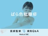 「ばら色粃糠疹」は人にうつるの？症状・原因についても解説！【医師監修】
