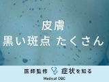 「皮膚に黒い斑点がたくさん」できる原因はご存知ですか？医師が徹底解説！