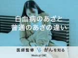 「白血病のあざと普通のあざの違い」はご存知ですか？症状についても解説！