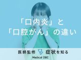 「口内炎」と「口腔がん」の違いはご存知ですか？医師が監修！