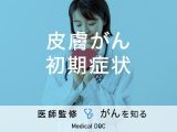 「皮膚がんの初期症状」はご存知ですか？原因・治療法も解説！【医師監修】