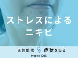 「ストレスでニキビ」ができる原因はご存知ですか？医師が徹底解説！