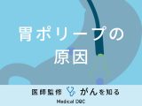 「胃ポリープができる原因」はご存知ですか？症状・予防法も医師が解説！