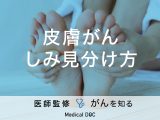 「皮膚がんとしみの見分け方」はご存知ですか？原因や治療法も解説！【医師監修】