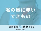 「喉の奥に赤いできもの」ができる原因はご存知ですか？医師が徹底解説！