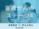 「盲腸がんステージ4」の症状・治療法・生存率はご存知ですか？医師が監修！