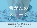 「舌がんのステージ分類」はご存知ですか？治療法や予後も解説！【医師監修】