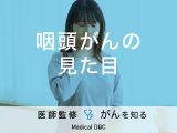 「咽頭がんは見た目」でわかる？症状や治療法も解説！医師が監修！