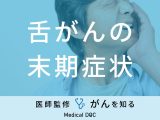 「舌がんの末期症状」はご存知ですか？治療法や生存率も解説！医師が監修！