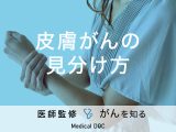 「皮膚がんの見分け方」はご存知ですか？症状やセルフチェック法も解説！