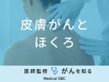 「皮膚がんとほくろ」の違いはご存知ですか？見分け方のポイントも解説！
