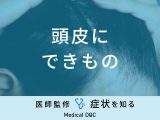 「頭皮にできもの」ができる原因はご存知ですか？医師が監修！