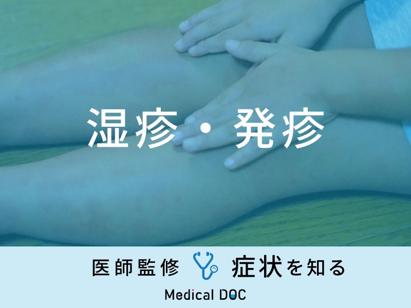 ロッキー山紅斑熱