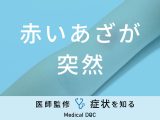 「赤いあざが突然」できる原因はご存知ですか？医師が徹底解説！