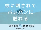 「蚊に刺されてパンパンに腫れる」ことはありませんか？医師が徹底解説！