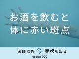 「お酒を飲むと体に赤い斑点」ができる原因はご存知ですか？医師が徹底解説！
