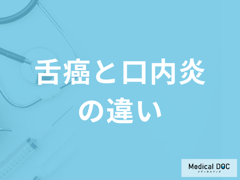 「舌癌と口内炎の違い」は舌のどこをチェックすれば良い？見分け方を医師が解説！