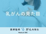 「乳がん」を発症すると「見た目」にどんな変化が現れる？医師が徹底解説！