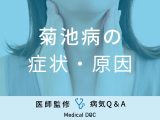 非公開: 「菊池病」を発症すると現れる症状・原因はご存知ですか？医師が監修！
