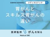 「胃がんとスキルス胃がんの違い」はご存知ですか？初期症状も医師が徹底解説！
