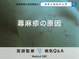「蕁麻疹の原因」はご存知ですか？症状や予防法も解説！【医師監修】