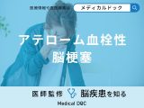 「アテローム血栓性脳梗塞」の症状はご存知ですか？ラクナ梗塞との違いも医師が解説！