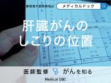 「肝臓がん」を発症すると「しこり」はどの位置にできる？症状や治療方法も解説！