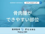 「骨肉腫ができやすい部位」はご存知ですか？大人・子供それぞれ医師が解説！