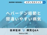 非公開: 手指が曲がってしまう「へバーデン結節」の検査方法について解説！【医師監修】