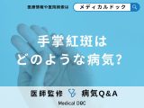 非公開: 「手掌紅斑（しゅしょうこうはん）」ができる原因はご存知ですか？【医師監修】