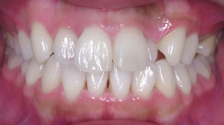 ひまわり歯科矯正歯科 全顎矯正⑥ before 正面