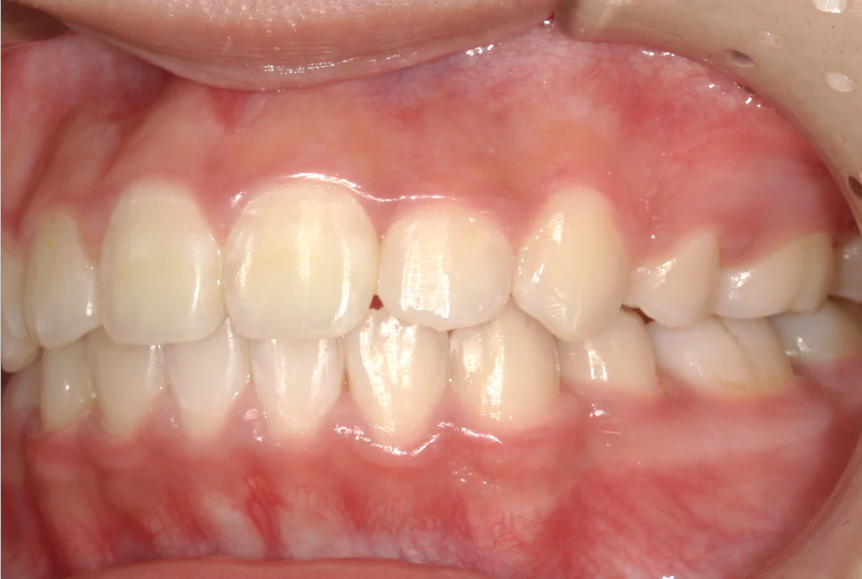 ひまわり歯科矯正歯科 全顎矯正③ after 左側面