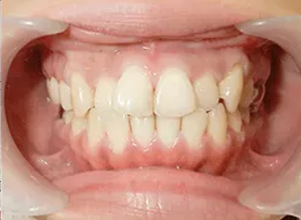 ロイヤル歯科クリニック代々木＋セラミック矯正＋before