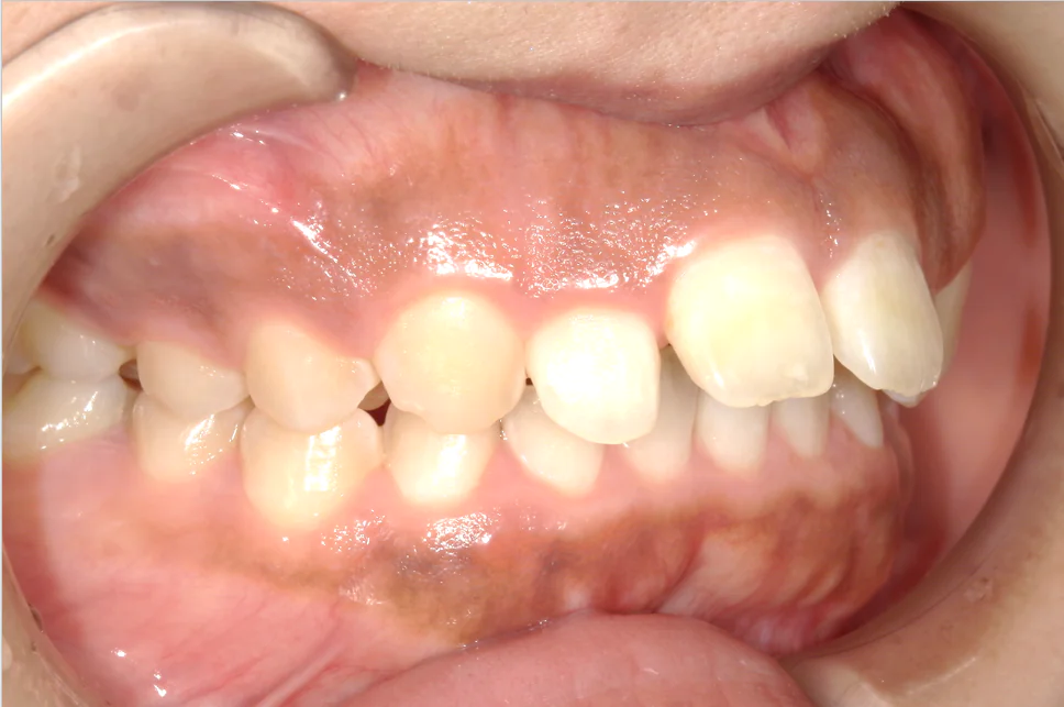 ひまわり歯科矯正歯科 部分矯正⑥ before 右側面