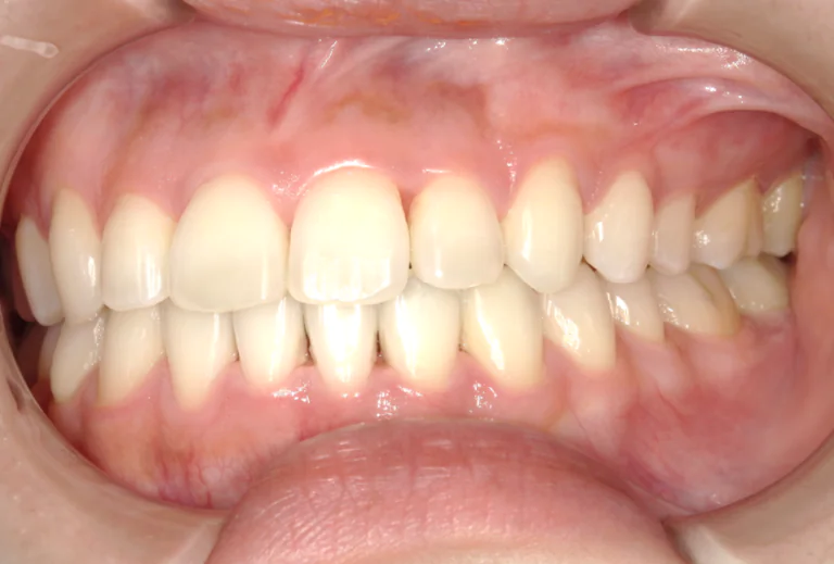 ひまわり歯科矯正歯科 全顎矯正⑥ after 左側面