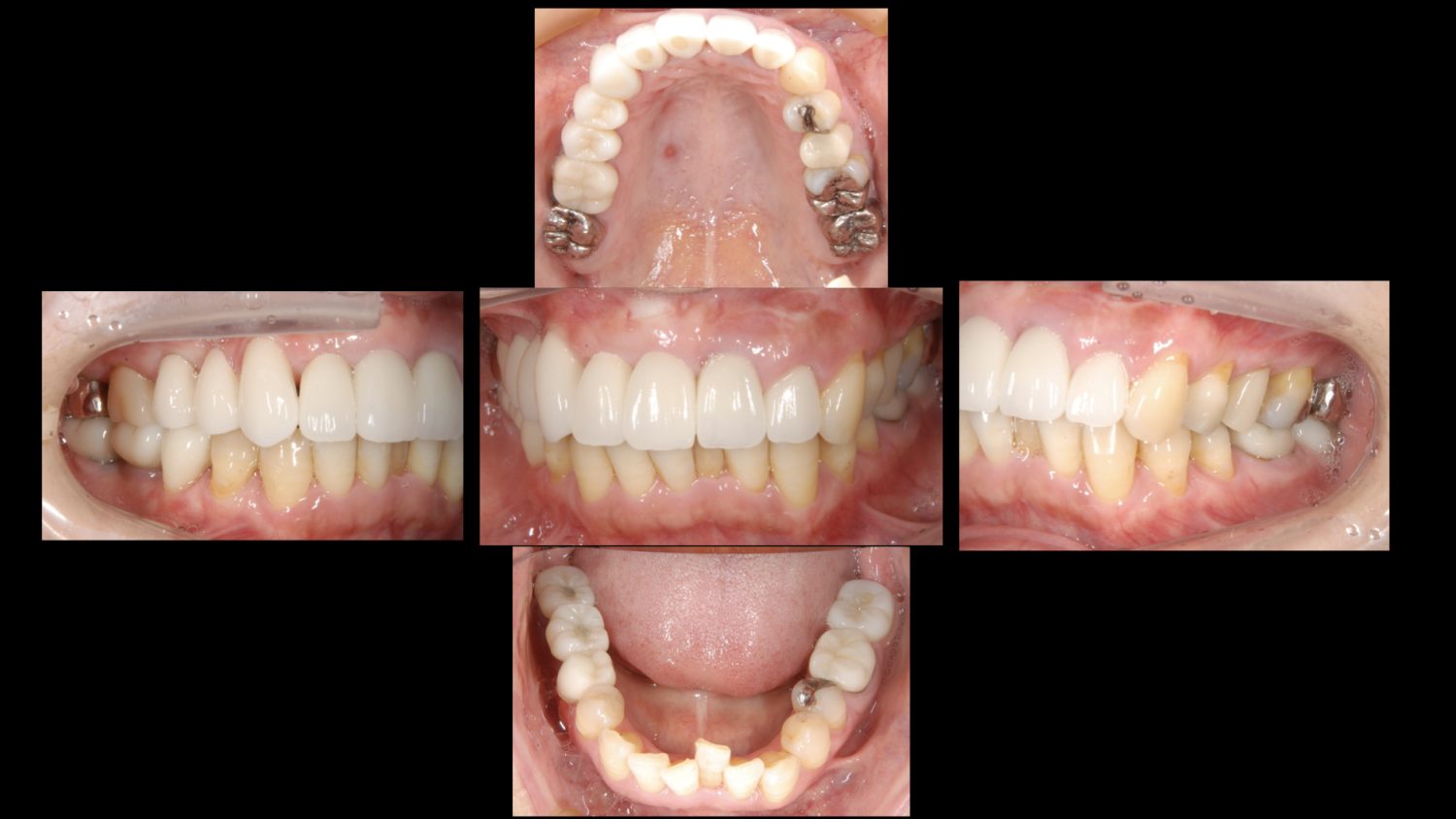 おぎの歯科医院 インプラント治療・セラミック治療① after