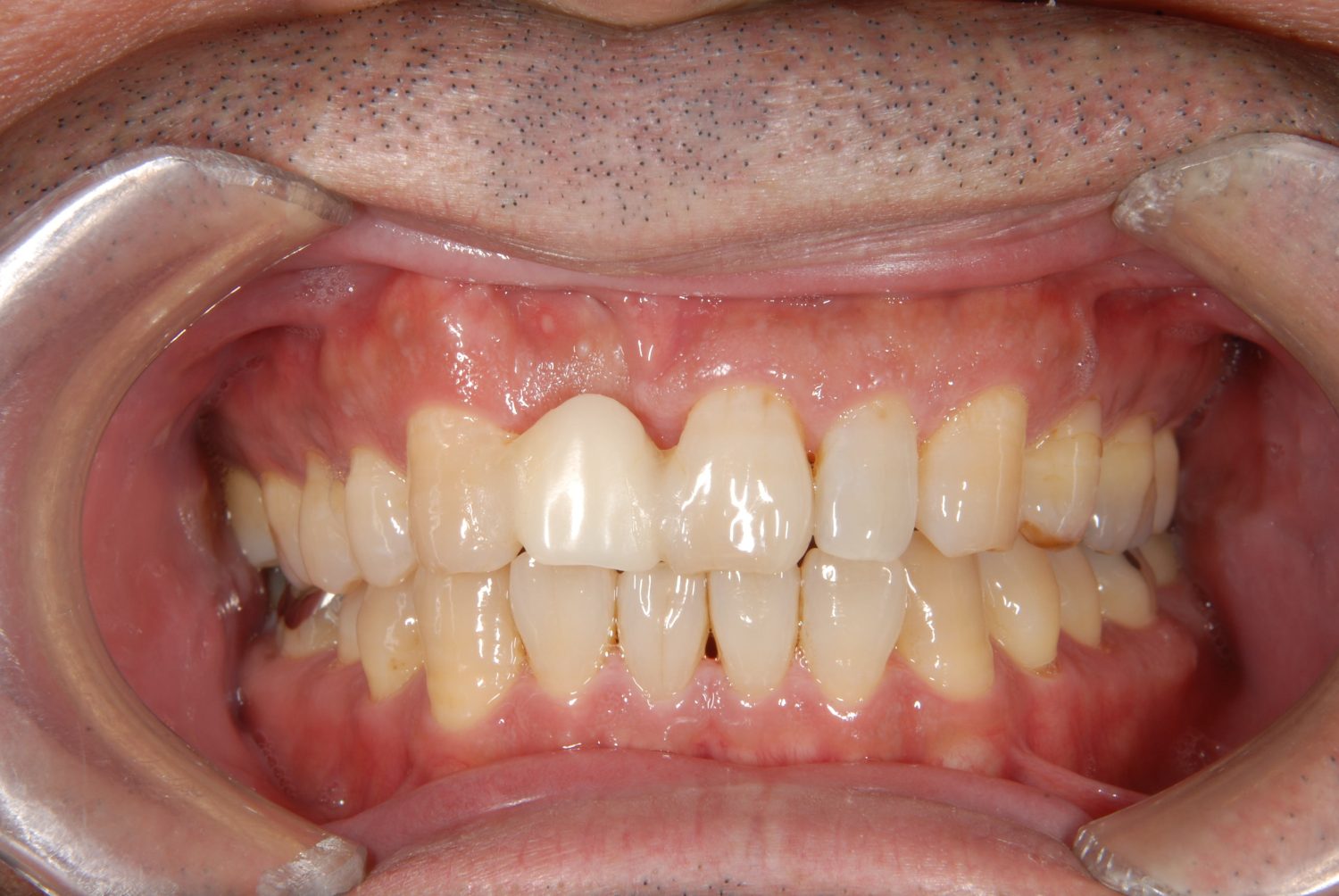 おぎの歯科医院 インプラント治療② before