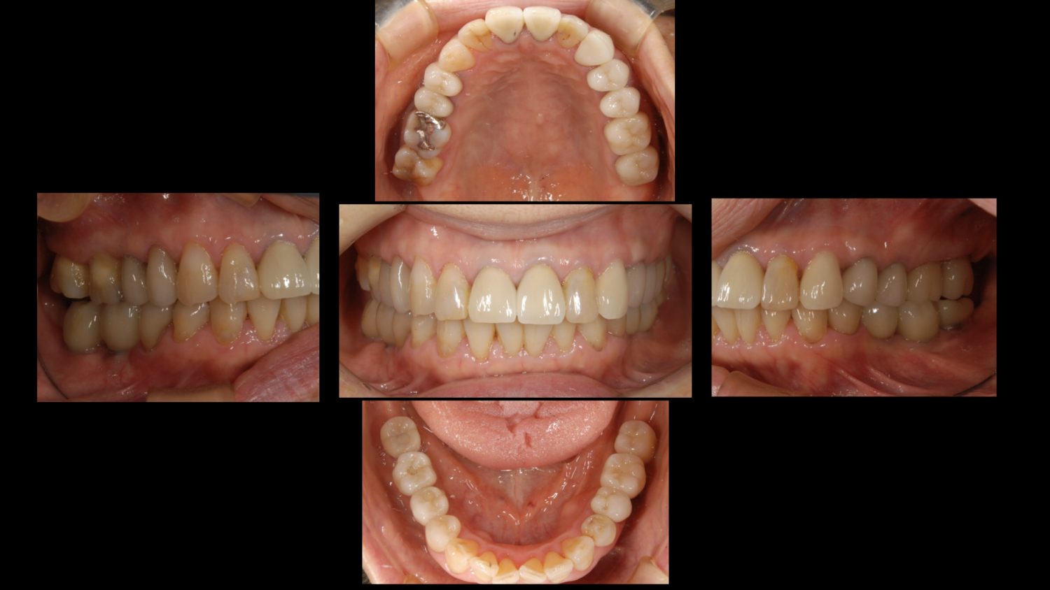 おぎの歯科医院 インプラント治療・セラミック治療② after