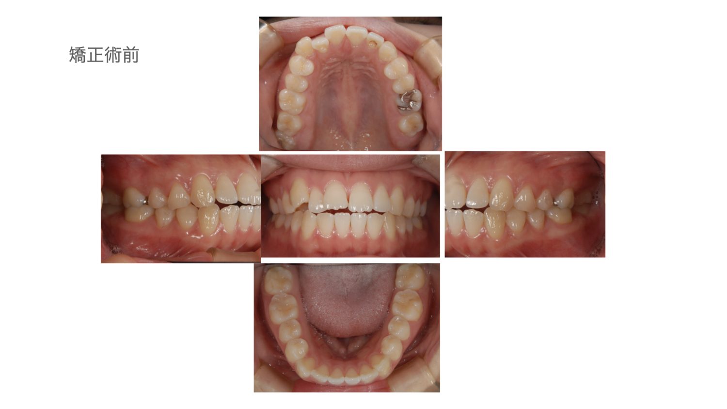 おぎの歯科医院 矯正治療 before